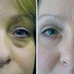 Eyelid surgery thailand before and after 150x150 Asian Eyelid Surgery Thailand   Blepharoplasty Thailand Prices Reviews