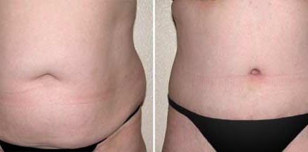 Tummy Tuck Thailand Abdominoplasty Thailand Reviews,Pictures Prices Tummy Tuck Thailand Surgery 437x216 Tummy Tuck Thailand Abdominoplasty Thailand Reviews,Pictures Prices