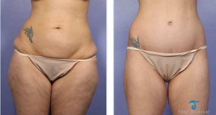 Tummy Tuck Thailand Abdominoplasty Thailand Reviews,Pictures Prices Tummy Tuck Thailand before and after 437x234 Tummy Tuck Thailand Abdominoplasty Thailand Reviews,Pictures Prices