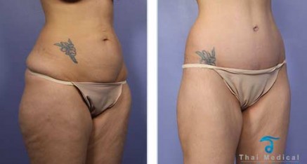 Tummy Tuck Thailand Abdominoplasty Thailand Reviews,Pictures Prices Tummy Tuck Thailand before and after picures 437x234 Tummy Tuck Thailand Abdominoplasty Thailand Reviews,Pictures Prices