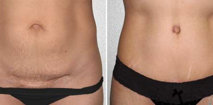 Tummy Tuck Thailand Abdominoplasty Thailand Reviews,Pictures Prices Tummy Tuck Thailand stretch marks 437x216 Tummy Tuck Thailand Abdominoplasty Thailand Reviews,Pictures Prices
