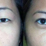 asia eyelid surgery thailand 150x150 Asian Eyelid Surgery Thailand   Blepharoplasty Thailand Prices Reviews