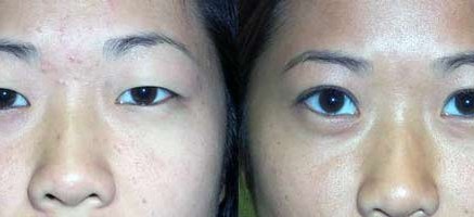 asia eyelid surgery thailand 437x200 Asian Eyelid Surgery Thailand   Blepharoplasty Thailand Prices Reviews
