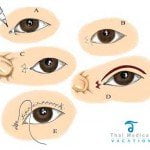 asian eyelid surgery diagram 150x150 Asian Eyelid Surgery Thailand   Blepharoplasty Thailand Prices Reviews