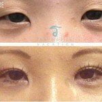 asian eye surgery before and after 2 150x150 Asian Eyelid Surgery Thailand   Blepharoplasty Thailand Prices Reviews
