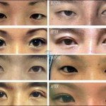 asian eye surgery before and after costs 150x150 Asian Eyelid Surgery Thailand   Blepharoplasty Thailand Prices Reviews