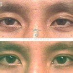 asian eye surgery before and after male 150x150 Asian Eyelid Surgery Thailand   Blepharoplasty Thailand Prices Reviews