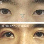 asian eye surgery before and after male2 150x150 Asian Eyelid Surgery Thailand   Blepharoplasty Thailand Prices Reviews