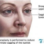 blepharoplasty thailand 150x150 Asian Eyelid Surgery Thailand   Blepharoplasty Thailand Prices Reviews