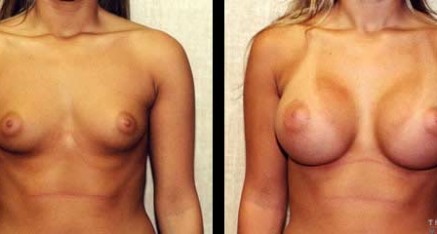 Breast Augmentation Thailand Bangkok Doctor Reviews,Pictures & Prices breast agmentation thailand 437x234 Breast Augmentation Thailand Bangkok Doctor Reviews,Pictures & Prices