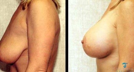 Breast Augmentation Thailand Bangkok Doctor Reviews,Pictures & Prices breast agmentation thailand breastlift 437x234 Breast Augmentation Thailand Bangkok Doctor Reviews,Pictures & Prices