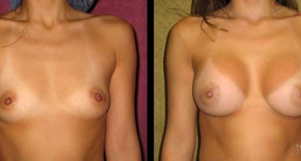 Breast Augmentation Thailand Bangkok Doctor Reviews,Pictures & Prices breast agmentation thailand implants bangkok 437x234 Breast Augmentation Thailand Bangkok Doctor Reviews,Pictures & Prices