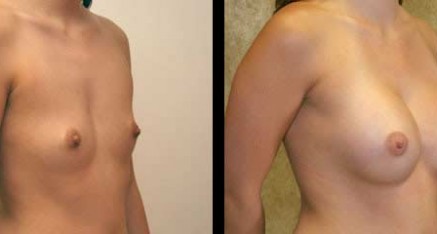 Breast Augmentation Thailand Bangkok Doctor Reviews,Pictures & Prices breast agmentations thailand implants bangkok 437x234 Breast Augmentation Thailand Bangkok Doctor Reviews,Pictures & Prices