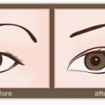 double eyelids asian eyelid surgery before after 150x150 Asian Eyelid Surgery Thailand   Blepharoplasty Thailand Prices Reviews