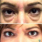 eyelid surgery thailand 150x150 Asian Eyelid Surgery Thailand   Blepharoplasty Thailand Prices Reviews