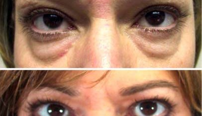 eyelid surgery thailand 406x234 Asian Eyelid Surgery Thailand   Blepharoplasty Thailand Prices Reviews