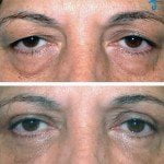 eyelid surgery thailand before after 150x150 Asian Eyelid Surgery Thailand   Blepharoplasty Thailand Prices Reviews