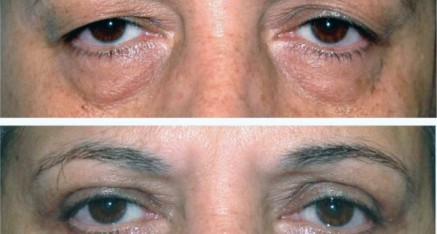 eyelid surgery thailand before after e1323044657372 437x234 Asian Eyelid Surgery Thailand   Blepharoplasty Thailand Prices Reviews