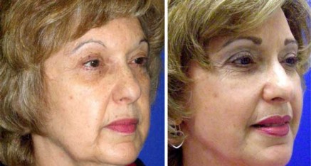 Facelift in Thailand Rhytidectomy,Mini Facelifts and Laser Face Lifts face lift thailand surgery 437x234 Facelift in Thailand Rhytidectomy,Mini Facelifts and Laser Face Lifts