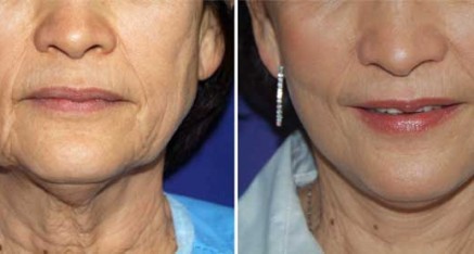 Facelift in Thailand Rhytidectomy,Mini Facelifts and Laser Face Lifts necklift facelift thailand 437x234 Facelift in Thailand Rhytidectomy,Mini Facelifts and Laser Face Lifts