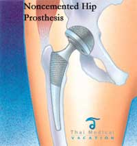 Hip Replacement in Thailand Hip Arthroplasty Overview, Costs & Alternatives non cemented hip replacement thailand Hip Replacement in Thailand Hip Arthroplasty Overview, Costs & Alternatives
