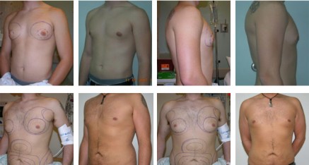Male Breast Reduction Thailand 437x234 Male Breast Reduction Thailand   Gynecomastia Thailand Reviews & Costs