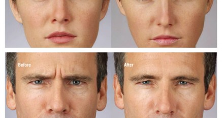 botox thailand before and after 437x234 Botox Thailand   Botox Bangkok   Botox Phuket