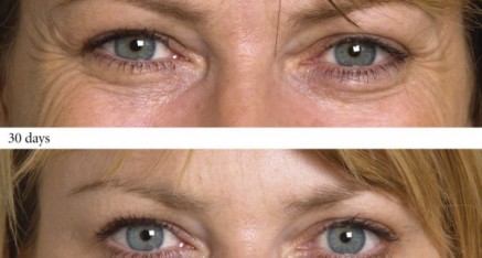 botox thailand before and after phuket 437x234 Botox Thailand   Botox Bangkok   Botox Phuket