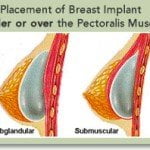 breast-implant-Thailand-placement breast implant Thailand placement 150x150 Breast Implants Thailand Breast Implants Bangkok