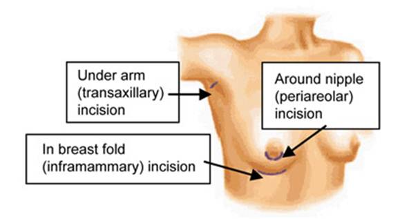 breast-implants-in-thailand-incision-placements breast implants in thailand incision placements Breast Implants Thailand Breast Implants Bangkok