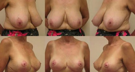 Breast Reduction Thailand Breast Reduction Bangkok Reduction Phuket breast reduction Thailand before and after 437x234 Breast Reduction Thailand Breast Reduction Bangkok Reduction Phuket