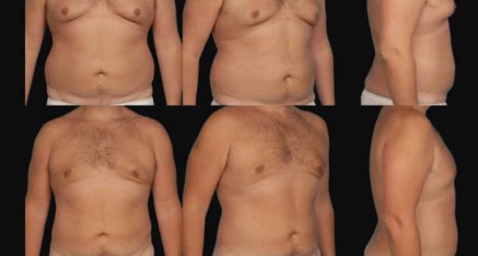 gynecomastia thailand 437x234 Male Breast Reduction Thailand   Gynecomastia Thailand Reviews & Costs