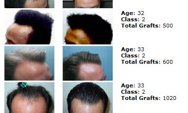 hair transplant in thailand surgery class2 387x234 Hair Transplant in Thailand  Hair Restoration in Thailand Reviews Cost