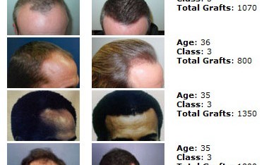 hair transplant in thailand surgery class3 391x234 Hair Transplant in Thailand  Hair Restoration in Thailand Reviews Cost