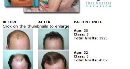 hair transplant in thailand surgery class5 437x234 Hair Transplant in Thailand  Hair Restoration in Thailand Reviews Cost