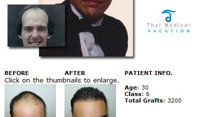 hair transplant in thailand surgery class6 402x234 Hair Transplant in Thailand  Hair Restoration in Thailand Reviews Cost