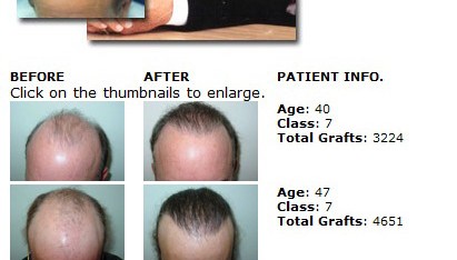hair transplant in thailand surgery class7 411x234 Hair Transplant in Thailand  Hair Restoration in Thailand Reviews Cost