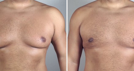male breast reduction in thailand 437x234 Male Breast Reduction Thailand   Gynecomastia Thailand Reviews & Costs