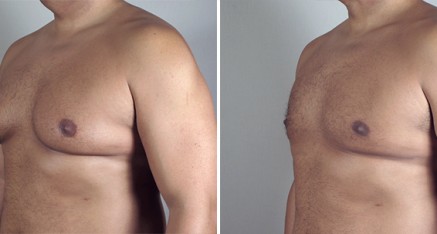 male breast reduction thailand 2 437x234 Male Breast Reduction Thailand   Gynecomastia Thailand Reviews & Costs