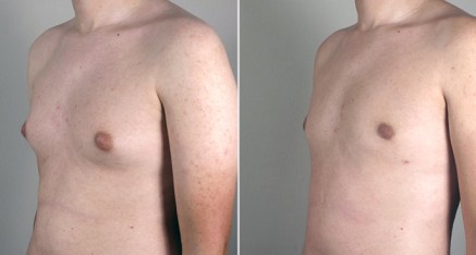 male breast reduction thailand 3 437x234 Male Breast Reduction Thailand   Gynecomastia Thailand Reviews & Costs