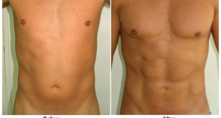 vaser hi def thailand 437x234 Vaser Thailand   Vaser Liposuction Thailand   Vaser Reviews,Pictures and Cost