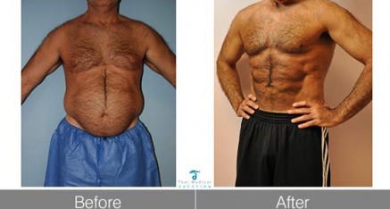 vaser hidef thailand before after 437x234 Vaser Thailand   Vaser Liposuction Thailand   Vaser Reviews,Pictures and Cost