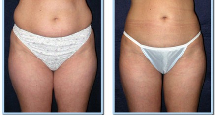 vaser lipo thailand 437x234 Vaser Thailand   Vaser Liposuction Thailand   Vaser Reviews,Pictures and Cost
