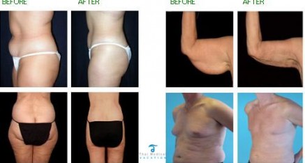 vaser thailand before and after pictures 437x234 Vaser Thailand   Vaser Liposuction Thailand   Vaser Reviews,Pictures and Cost