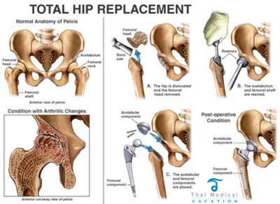 Total Hip Replacement Surgery in Spain - Procedure, Implants