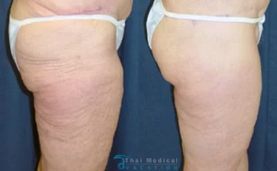 Understanding Thigh Lifts: Medial, Bilateral, Vertical, and Mini