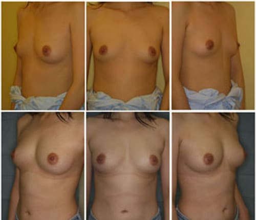 prepuberty-breasts-pics