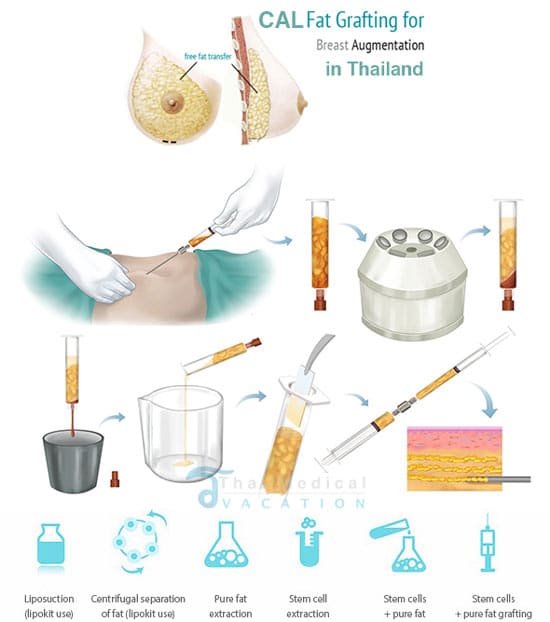 Genuine Stem Cell Breast Augmentation in Thailand